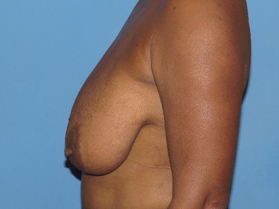 before breast lift no implants left side view female patient case 5848