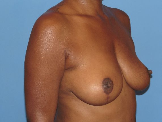 after breast lift no implants right angle view female patient case 5848
