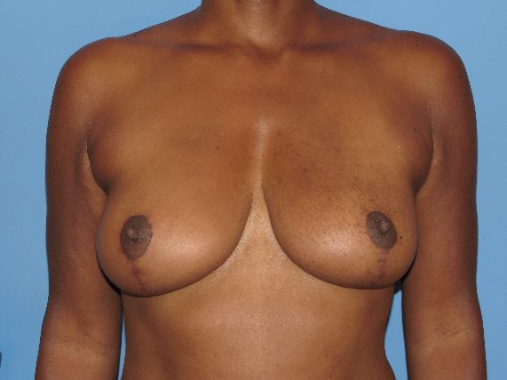 after breast lift no implants front view female patient case 5848