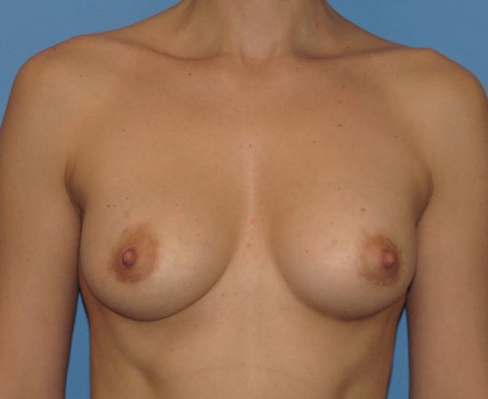 after breast augmentation with lift front view female patient case 5986