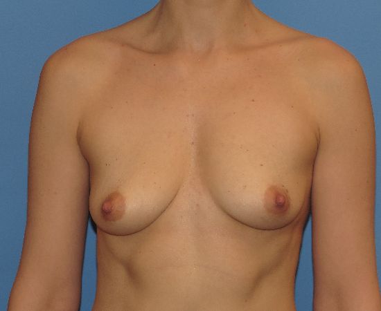 before breast augmentation with lift front view female patient case 5986