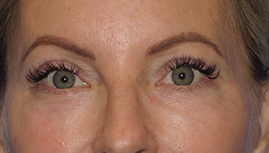 after eyelid surgery front view female patient case 6097