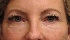 before eyelid surgery front view female patient case 6097