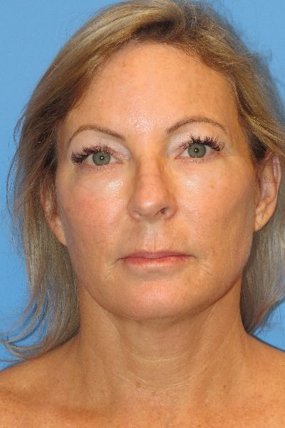 before facelift front side view female patient case 6086