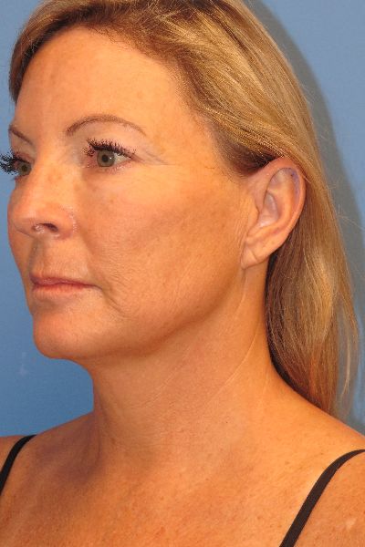 before facelift left angle view female patient case 6086