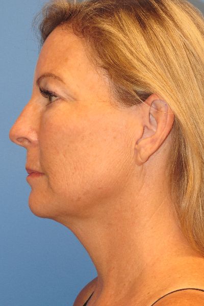 before facelift left side view female patient case 6086