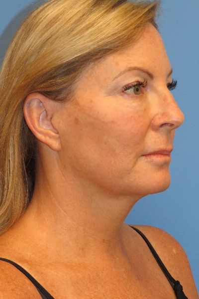 before facelift right angle view female patient case 6086