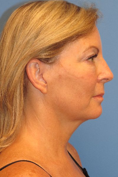 before facelift right side view female patient case 6086