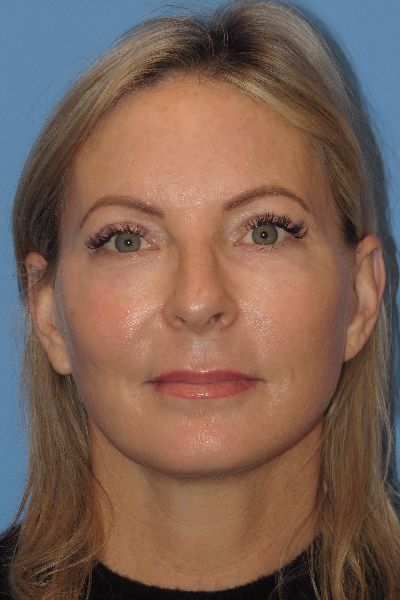 after facelift front side view female patient case 6086