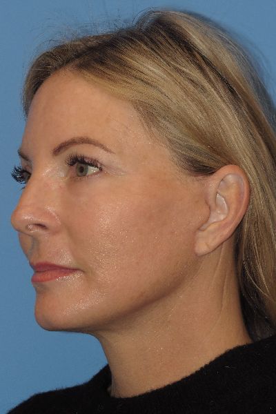 after facelift left angle view female patient case 6086