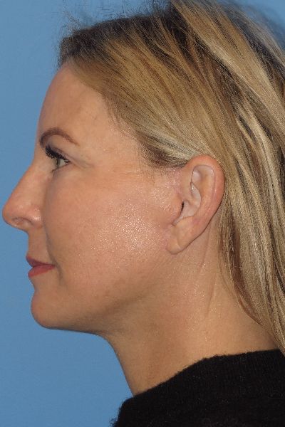 after facelift left side view female patient case 6086