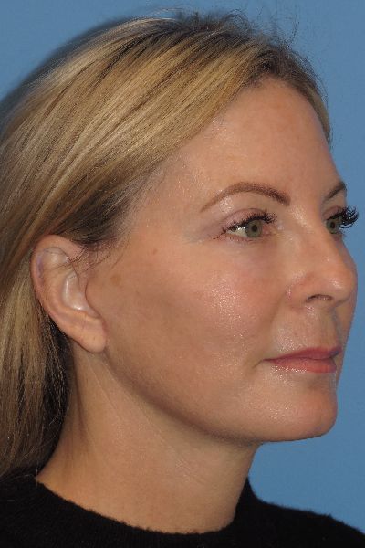 after facelift right angle view female patient case 6086