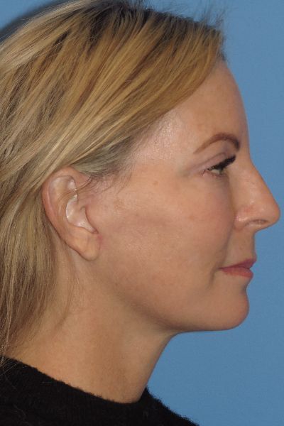 after facelift right side view female patient case 6086