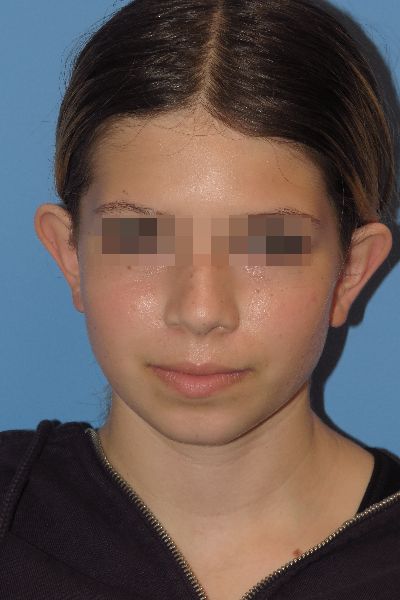 before otoplasty front view female patient case 6111