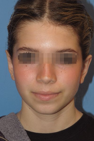after otoplasty front view female patient case 6111