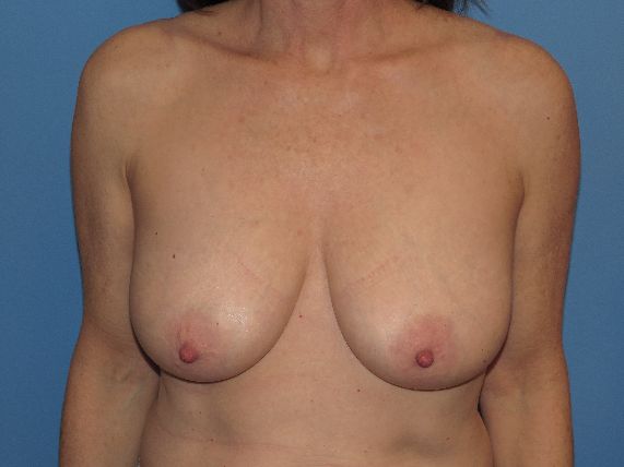 before breast lift no implants front view female patient case 6172