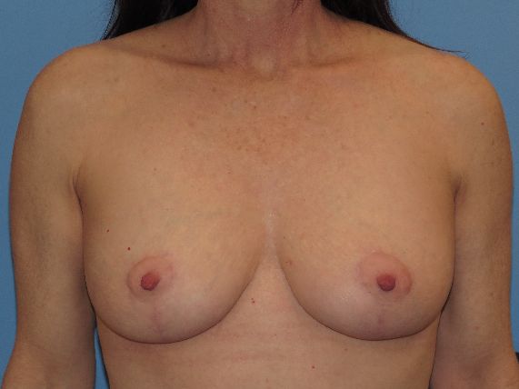 after breast lift no implants front view female patient case 6172