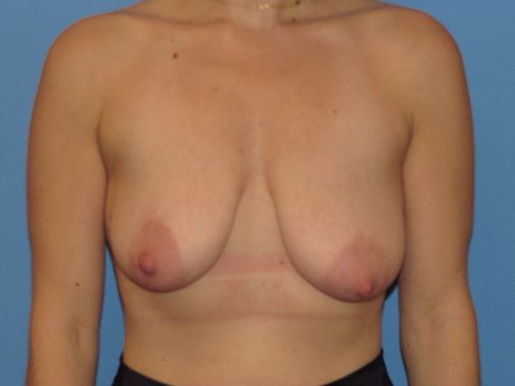 before breast reduction front view female patient case 6139