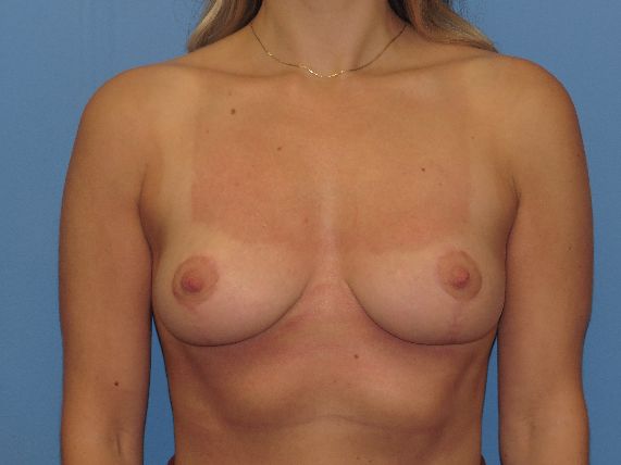 after breast reduction front view female patient case 6139