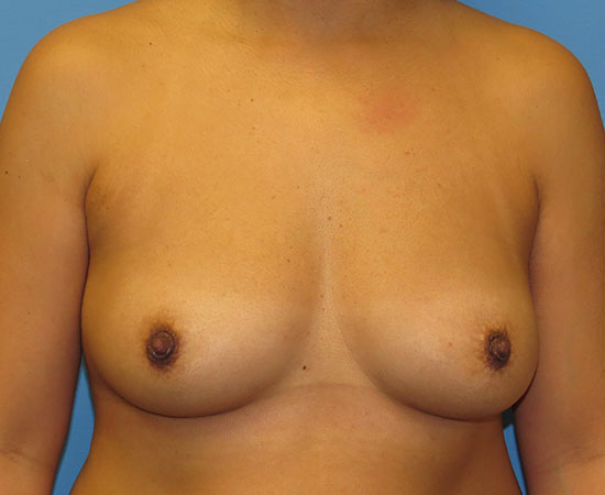 before breast augmentation front view female patient case 6377