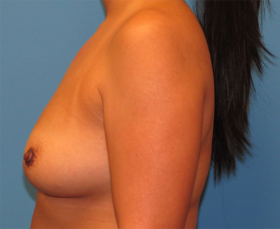 before breast augmentation left side view female patient case 6377
