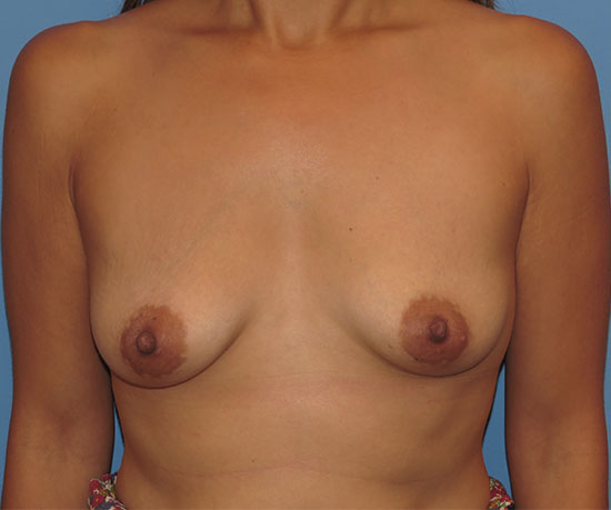 before breast augmentation front view female patient case 6397