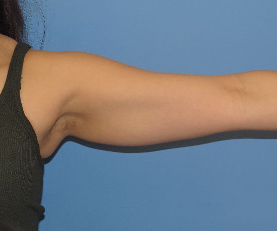 before liposuction front arm view female patient case 6475