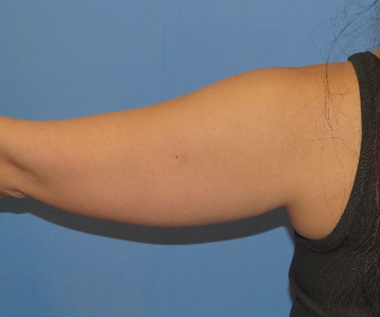 before liposuction back arm view female patient case 6475