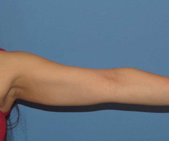 after liposuction front arm view female patient case 6475