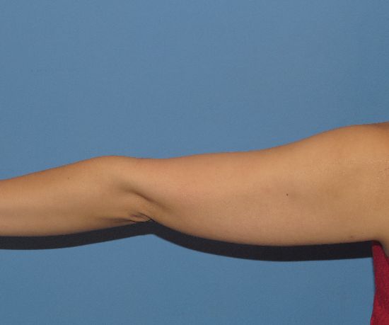 after liposuction back arm view female patient case 6475