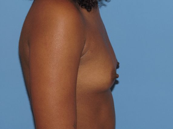 before breast augmentation right view female patient case 6667