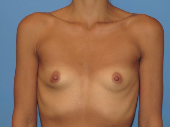 before breast augmentation front view female patient case 6678