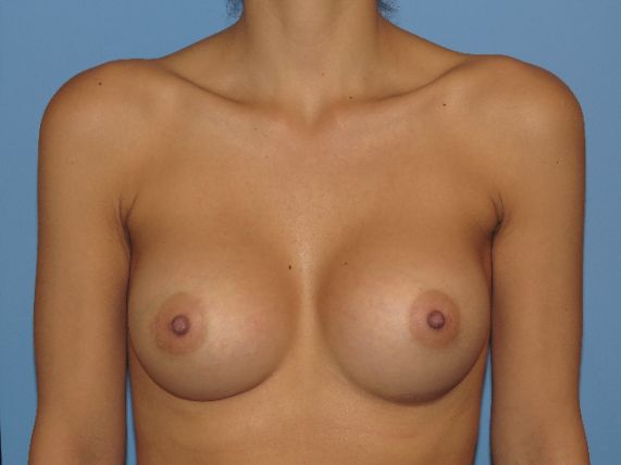 after breast augmentation front view female patient case 6678