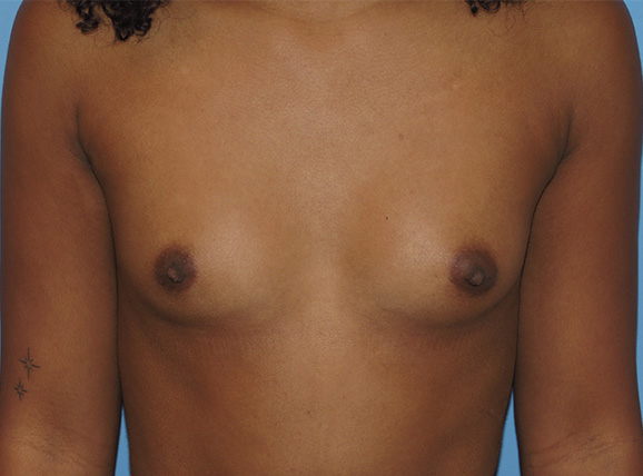 before breast augmentation front view female patient case 6667