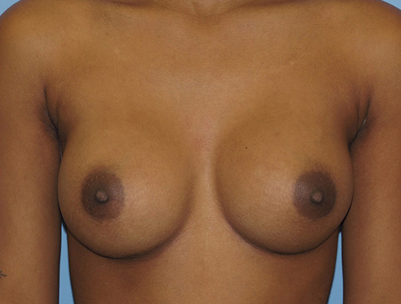 after breast augmentation front view female patient case 6667