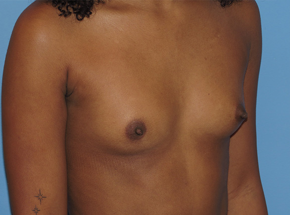 before breast augmentation right angle view female patient case 6667