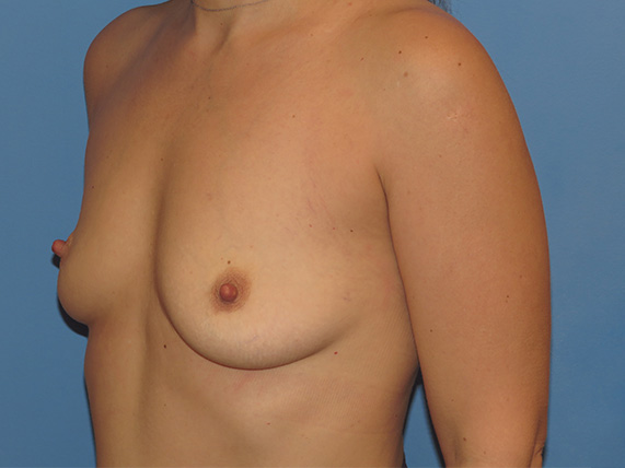 before breast augmentation left angle view female patient case 6693