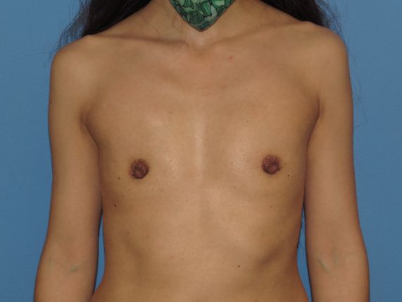 before breast augmentation front view female patient case 6818