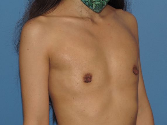 before breast augmentation left angle view female patient case 6818