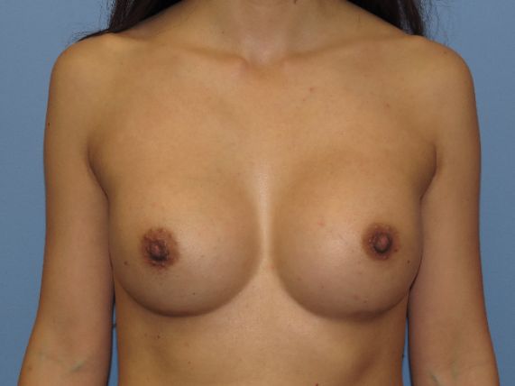 after breast augmentation front view female patient case 6818