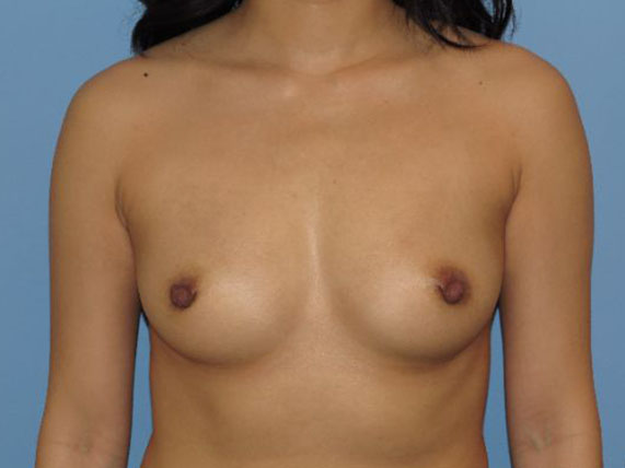 before breast augmentation front view female patient case 6852