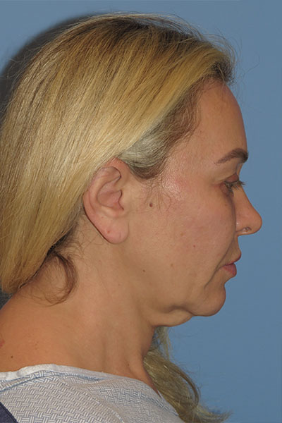 before facelift left side view female patient case 6868