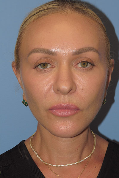 after facelift front view female patient case 6868
