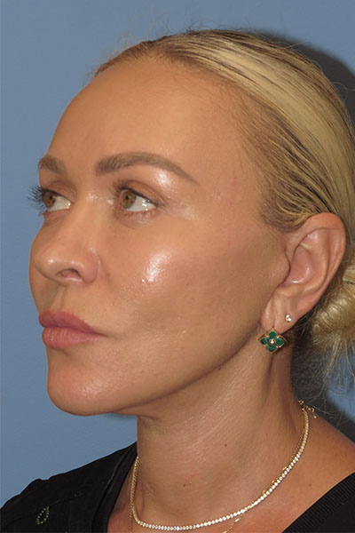 after facelift right angle view female patient case 6868