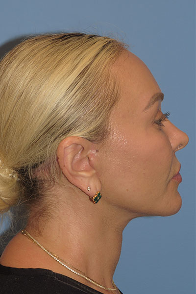 after facelift left side view female patient case 6868