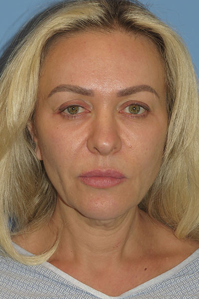 before facelift front view female patient case 6868