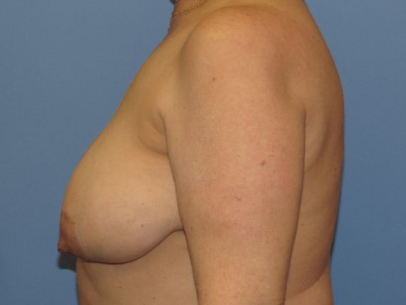 before breast lift no implants right side view female patient case 6885