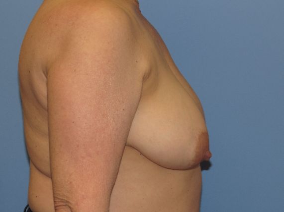 before breast lift no implants left side view female patient case 6885