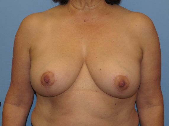 after breast lift no implants front view female patient case 6885