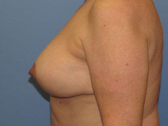 after breast lift no implants right side view female patient case 6885